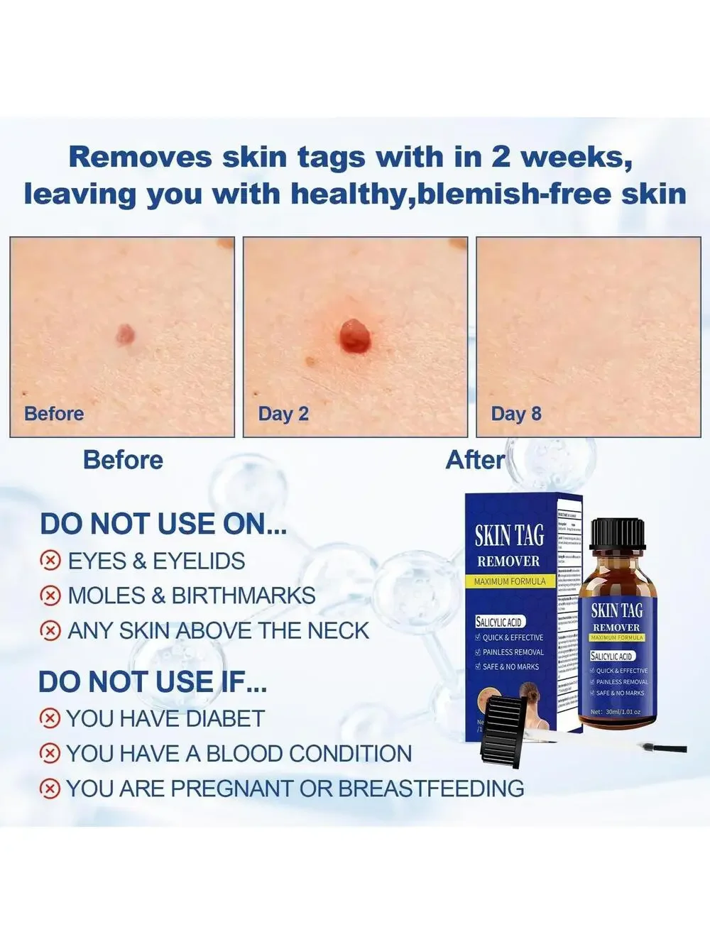 Fast-Acting Skin Tag Remover, Maximum Formula 30ml